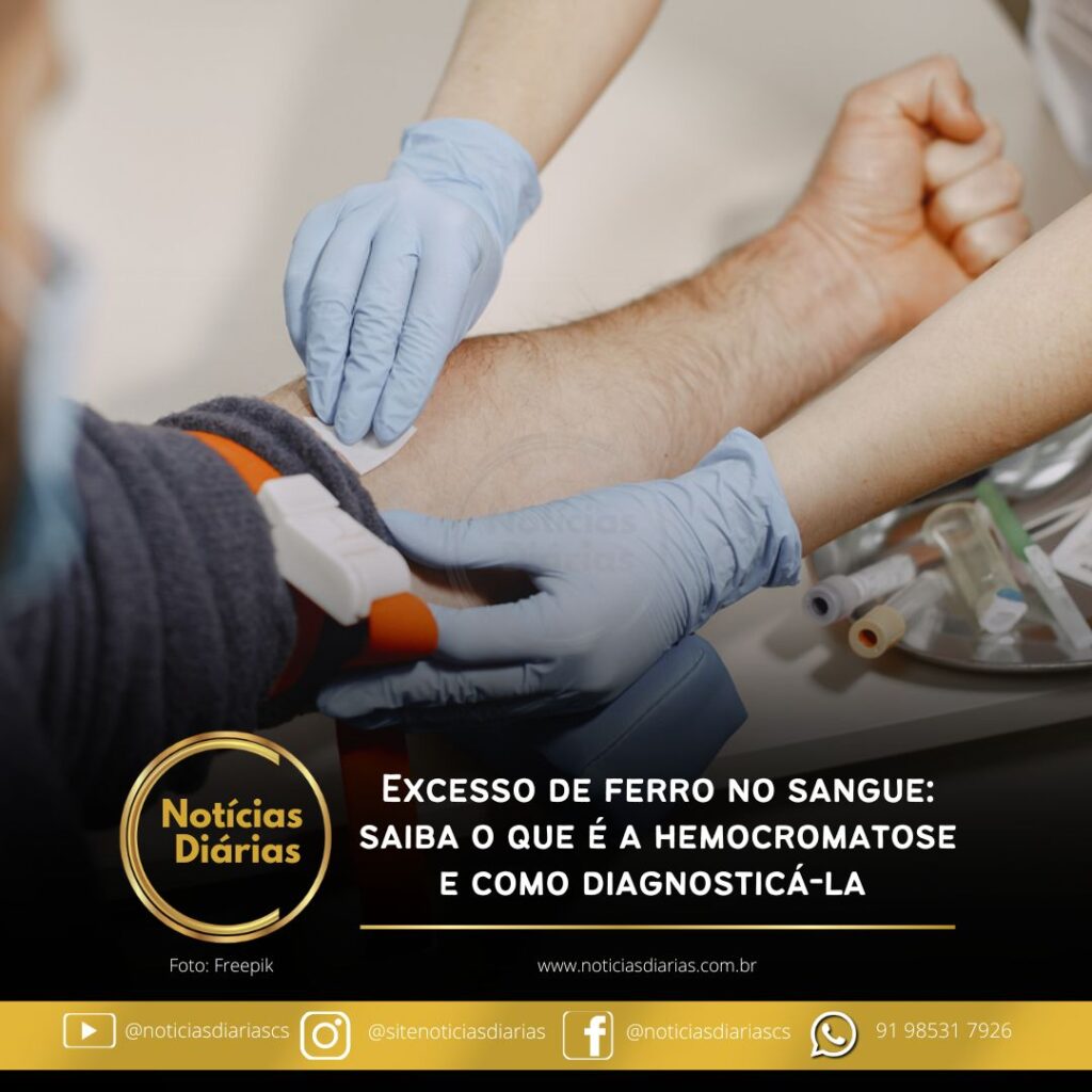 O ferro é um mineral essencial para o organismo, mas seu acúmulo pode causar danos sérios à saúde. A hemocromatose é um distúrbio no qual o corpo absorve mais ferro do que o necessário dos alimentos, e um diagnóstico preciso pode prevenir complicações graves em diversos órgãos, como fígado, coração, pâncreas e articulações.